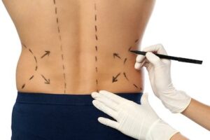 BodyTite Liposuction